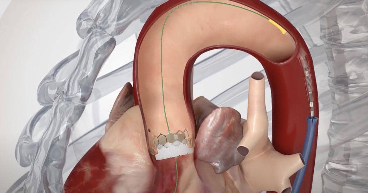Comparing Balloon-Expandable and Self-Expanding Valves in Transcatheter Aortic Valve Replacement: Which Offers Superior Outcomes?