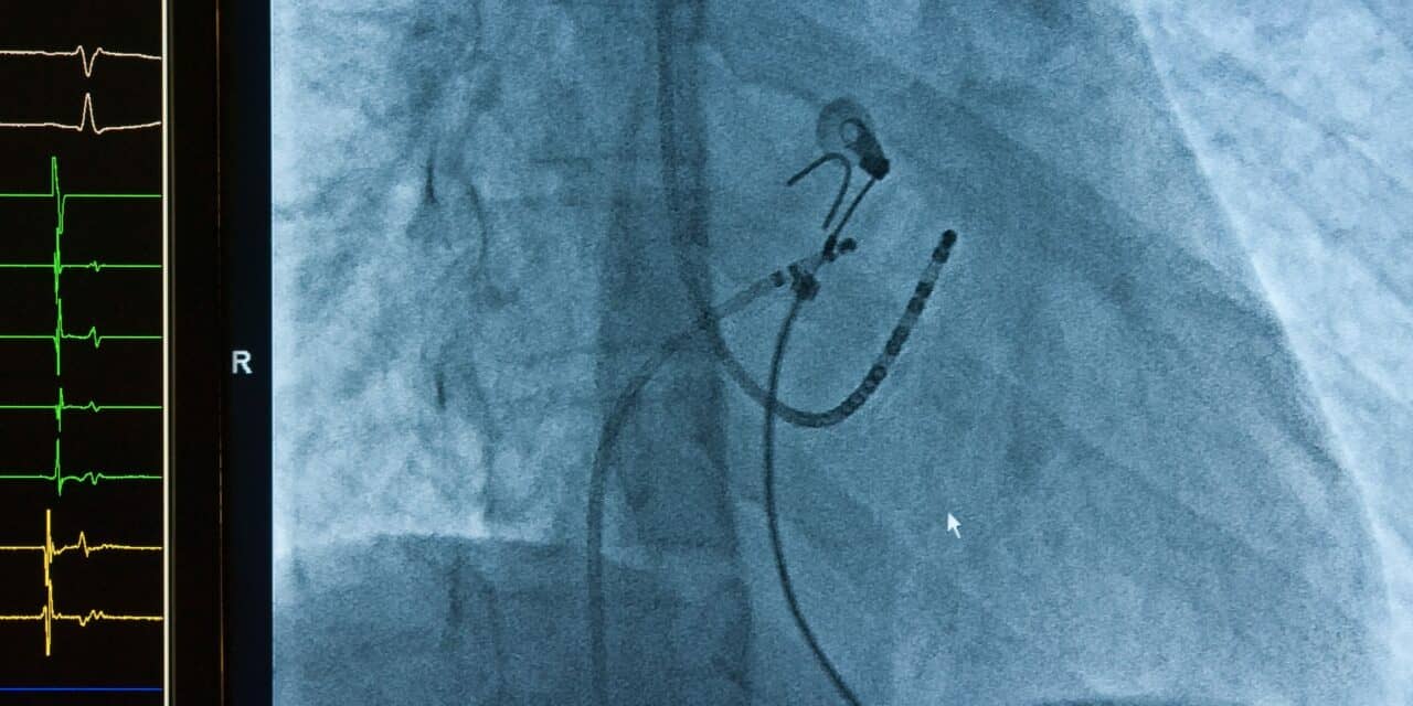 Atrial Fibrillation Ablation Lowers Death Rates in Heart Failure Patients