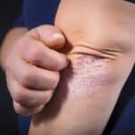 Psoriasis Severity and Duration Tied to Higher Cardiovascular Risk