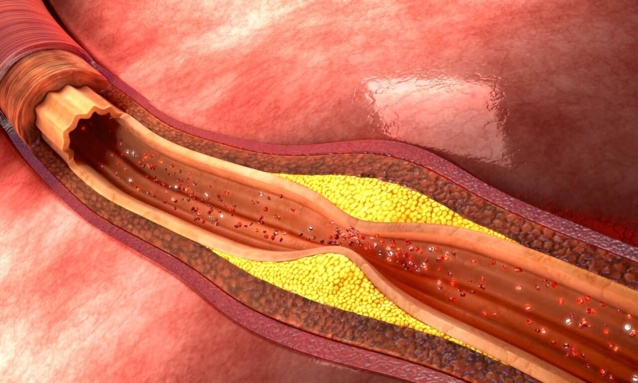 Study Validates Tool’s Efficacy in Predicting 10-Year Atherosclerosis Risk