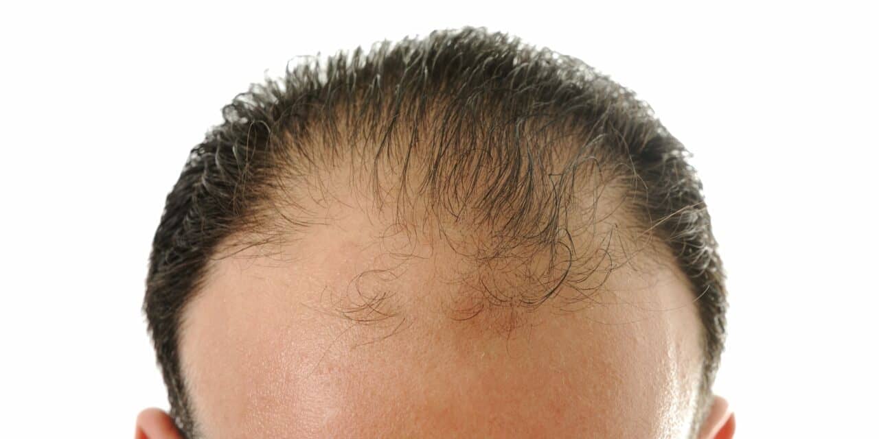 Drug for Male Pattern Baldness Surprisingly Lowers Cholesterol