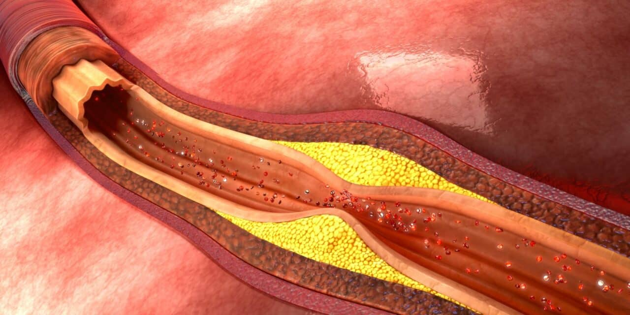 Cancer-like Features Found in Atherosclerosis