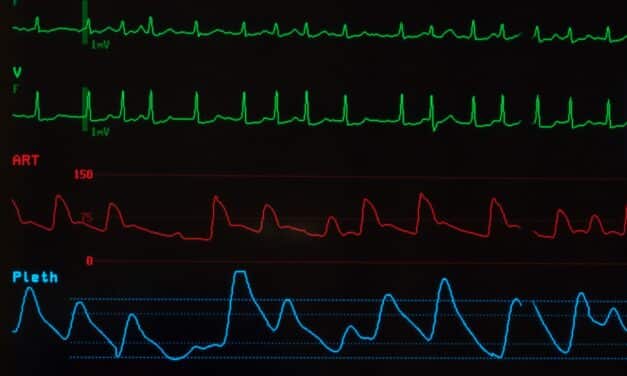 Pulsed Field Ablation Safe for Atrial Fibrillation Patients