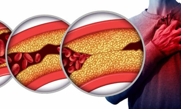 Routine Atherectomy Fails to Improve Stent Outcomes in Severely Calcified Arteries