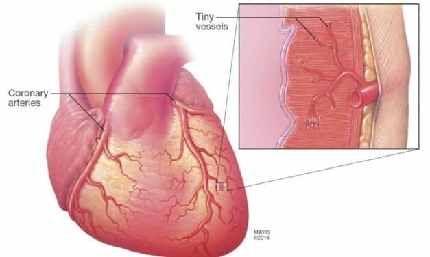 New Stent Design Eases Severe Chest Pain From Microvascular Disease