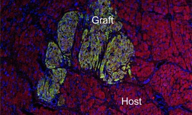 Stem Cell-Derived Heart Cells Show Promise for Congenital Heart Defects