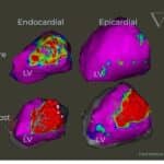 FDA Grants Breakthrough Designation to VT Ablation System