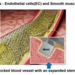 Laser-Patterned Stent Shows Promise in Preventing Restenosis and Promoting Vascular Recovery