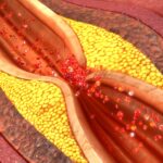 Post-COVID Inflammation Fuels Ongoing Coronary Artery Plaque Growth
