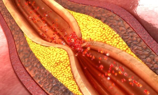 Post-COVID Inflammation Fuels Ongoing Coronary Artery Plaque Growth